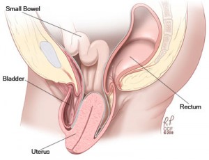 obgyn-uterine-prolapse